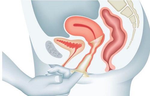 Image result for 'फीमेल कंडोम'